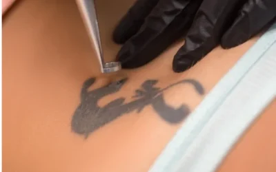 Eliminar un tatuaje también es cuidarte: cuando la piel pide un nuevo comienzo
